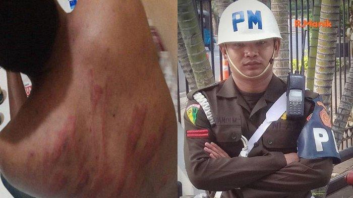 Kondisi tubuh ZF, pemuda asal Sawang, Aceh Utara, yang ditangkap dan disiksa oknum Paspampres, Praka RM, pada April 2023 lalu.