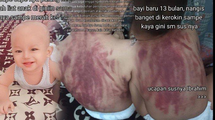 Viral Punggung Bayi Dikerok Pakai Koin Sampai Merah, Sang Ibu Ungkap Pengakuan Suster Bikin Terkejut