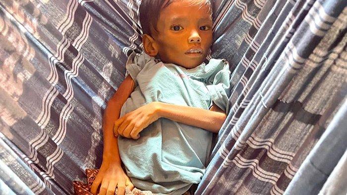 KONDISI BOCAH -  Begini kondisi bocah, Al Muttaqim (2,8) menderita tumor ginjal di Gampong Meuke Beurabo, Kecamatan Padang Tiji, Pidie, Selasa (17/6/2025).