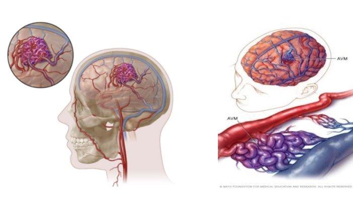 Ilustrasi Arteriovenous Malformation (AVM)
