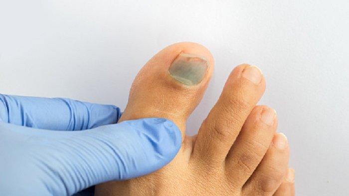 Kuku Kaki Menghitam Bisa Jadi Pertanda Gejala Penyakit Serius