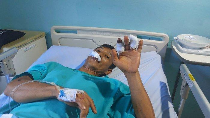 Dede Dwi (41), warga Kenanga Kabupaten Bangka menunjukkan jari tangan kirinya yang hlang akibat disambar buaya saat dirawat di RSUD Depati Bahrin Senin (10/6/2024). Dede disambar buaya saat memancing udang di pinggir aliran Sungai Baturusa Minggu (9/6/2024).