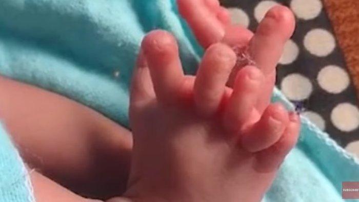 Bayi di India lahir dengan 26 jari