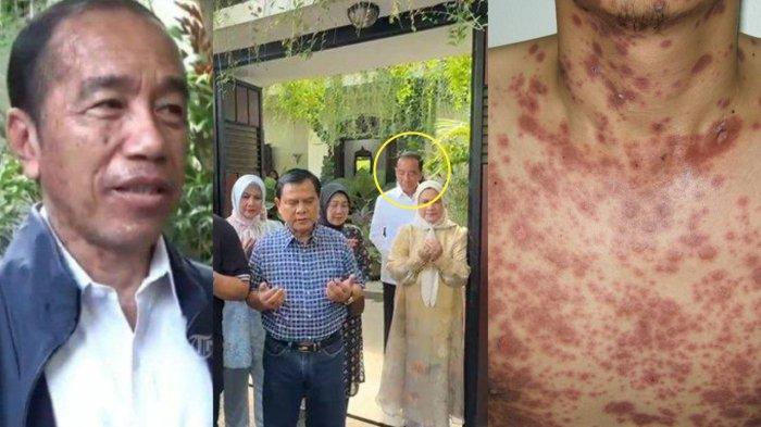 JOKO WIDODO - Kolase foto-foto terbaru Jokowi (tengah-kiri) dan kondisi pasien sindrom Stevens-Jhonsons (kanan). Inilah foto-foto terbaru Jokowi usai disebut idap penyakit langka Sindrom Stevens-Jhonson. Ia merayakan ultah ke 64 di kediamannya pada Sabtu (21/6).