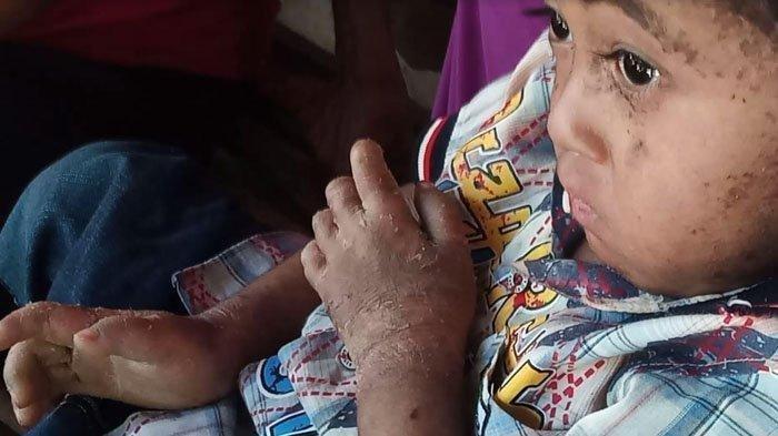 Kondisi kulit Alfi Azka (3). Balita Dusun/Desa Tulung, Kecamatan Saradan, Kabupaten Madiun, tersebut mengidap penyakit langka Epidermolisis Bulosa, Kamis (30/5/2024)