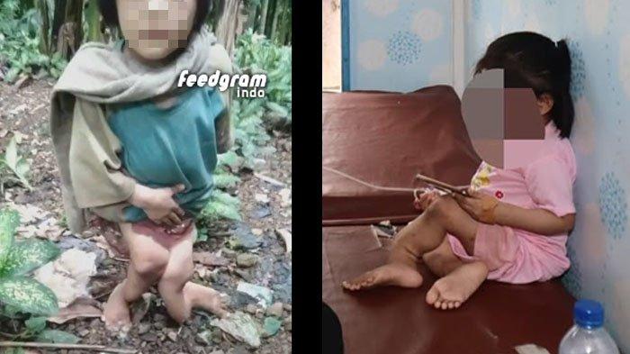 Kondisi kaki bocah perempuan di Nias Selatan yang diduga dianiaya keluarga besarnya selama bertahun-tahun