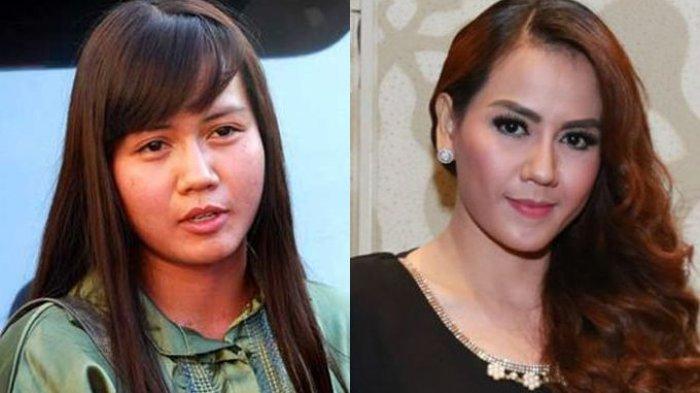 Nita Thalia sebelum dan sesudah operasi plastik