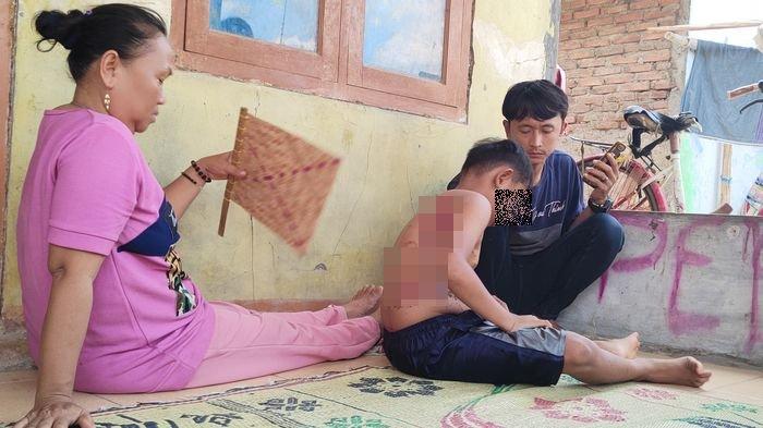 Kondisi bocah 10 tahun yang jadi korban penyiraman air panas oleh buyutnya saat sudah diamankan di rumah ayahnya di Desa Lempuyang, Kecamatan Anjatan, Kabupaten Indramayu, Kamis (8/2/2024).