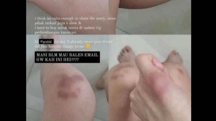 Kondisi memar-memar di tubuh korban kekerasan dan pemerasan sopir taksi online.