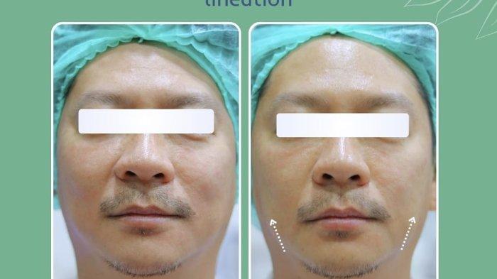 Perawatan re-LIFT HIFU dari Klinik Aesthetic di Bandung yaitu Klinik Utama Lineation ha