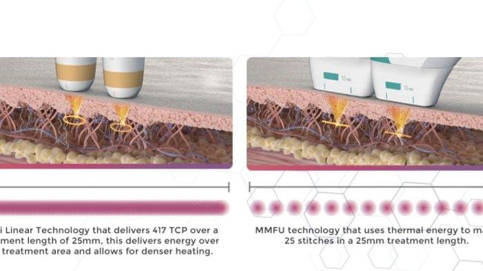 teknologi re-LIFT HIFU dari Klinik Aesthetic di Bandung yaitu Klinik Utama Lineation ha
