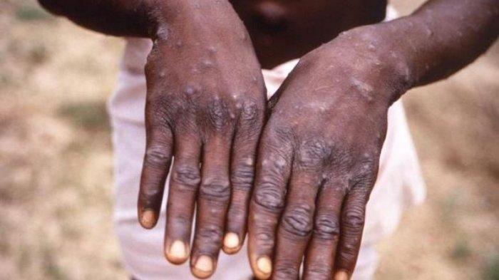 Cara cegah cacar monyet atau monkeypox yang dilakukan Pelabuhan di Tanjungpinang, Batam, dan Riau. Kenali gejalanya dan cara pencegahan agar tak tertu