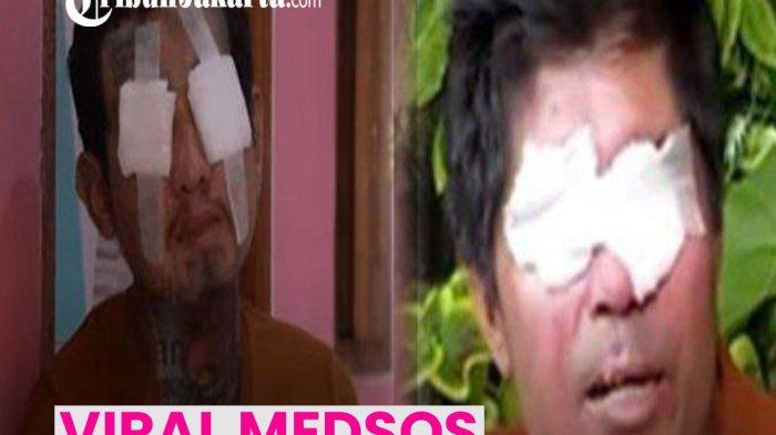Kasus Agus Salim korban penyiraman air keras kini dibandingkan warganet dengan kasus yang menimpa Faisal, korban mata dicongkel.