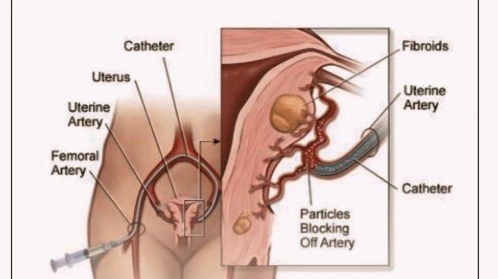 Embolisasi arteri uterina (UAE) Opsi Perawatan Fibroid Uterus