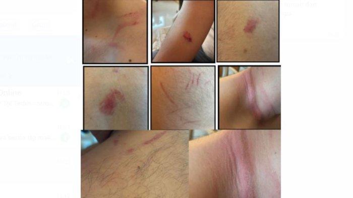 Anggota DPRD Provinsi Jambi berinisial MRRU mengalami sejumlah luka akibat dianiaya.