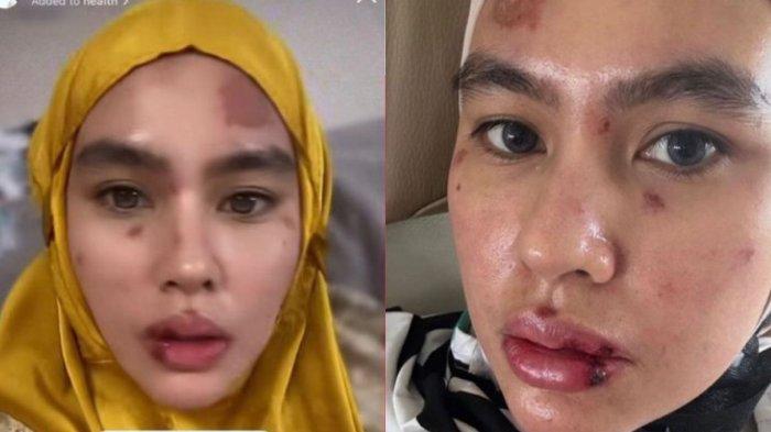 Kartika Putri kesal dinyinyiri netizen karena wajah dan lidahnya melepuh seperti terbakar,