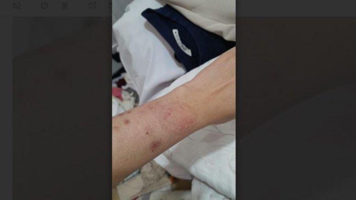 Luka di tangan WI, istri Anggota DPRD Provinsi Jambi WRRU.