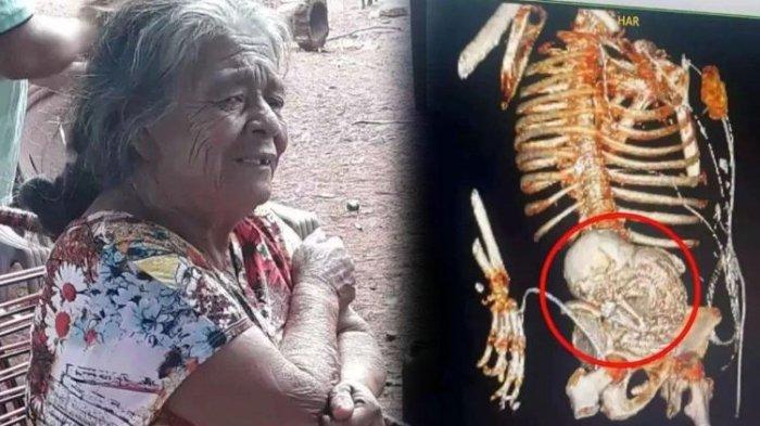 Nenek 81 Tahun Kaget Perutnya Ada Janin