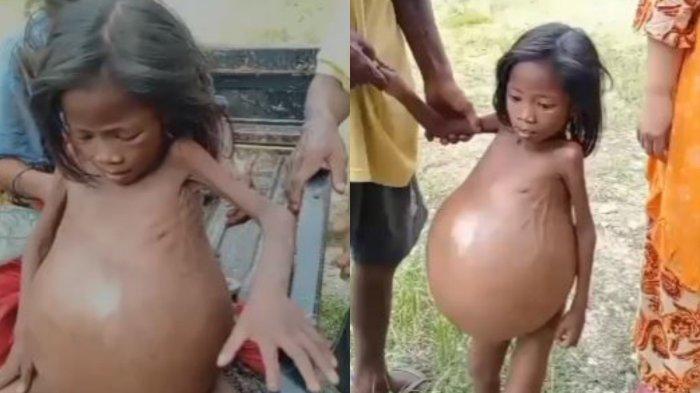 Aliya anak warga Suku Anak Dalam atau SAD di Jambi perutnya membesar. Kini dia telah meninggal