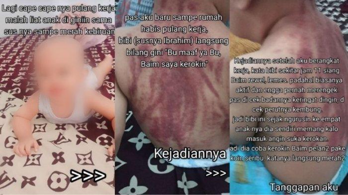 Seorang ibu curhat di media sosial, lantaran menemukan anaknya dengan kondisi merah-merah pada punggungnya usai dikerok oleh pengasuhnya.