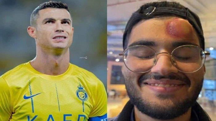 Benjol Seperti Bakpau! Ini Kondisi Kepala Kameramen yang Diduga Terkena Bola Tendangan Bebas Ronaldo