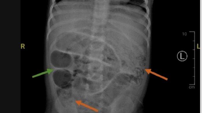 PERUT ANAK SEMINGGU TAK BAB - Foto hasil rontgen anak usia 3 tahun di Jember yang membuncit di RSD dr Soebandi Jember, Minggu (13/4/2025). Anak di kabupaten Jember itu mengeluh tak bisa BAB, alam sakit perut, muntah dan sesak napas sejak seminggu belakangan, ternyata ada gumpalan cacing di ususnya.