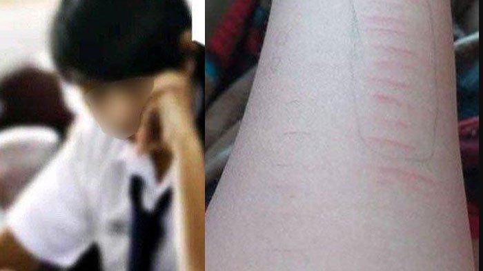 Ilustrasi siswa SMP sayat tangan sendiri menggunakan benda tajam
