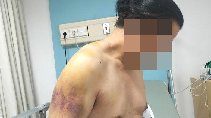 Valentino menunjukkan luka di lengan kanannya seusai dihajar, dan diculik sejumlah orang saat berada di samping Mapolrestabes Surabaya, Minggu (8/10/2023).