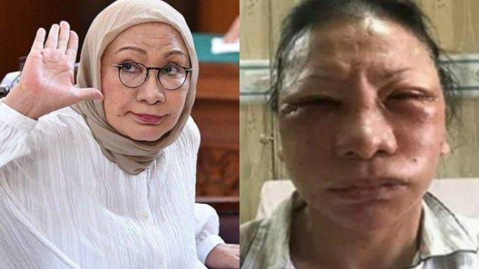Ratna Sarumpaet akhirnya menjelaskan alasan sebenarnya bebohong melakukan operasi plastik (oplas).