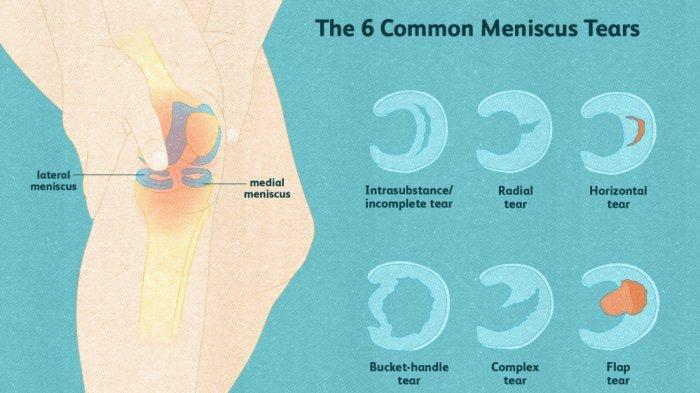 Meniscus Rupture adalah kondisi pecah atau robeknya meniskus (tulang rawan elastis dan keras berbentuk C atau bulan sabit) yang berada di lutut.