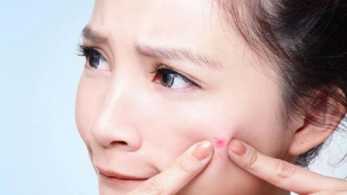5 Arti Mimpi Jerawat Menurut Mitos, Konon Akan Jadi Pertanda Ini!