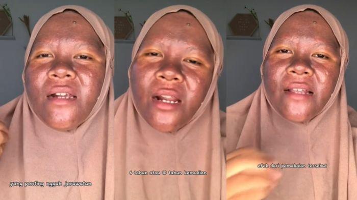 Tak sadar pakai krim berbahan merkuri, wajah konten kreator asal Balikpapan ini malah gosong.