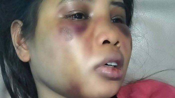 KORBAN - Asisten rumah tangga, Intan disiksa majikannya di kawasan Sukajadi, Kota Batam, Provinsi Kepri, Minggu (22/6/2025).