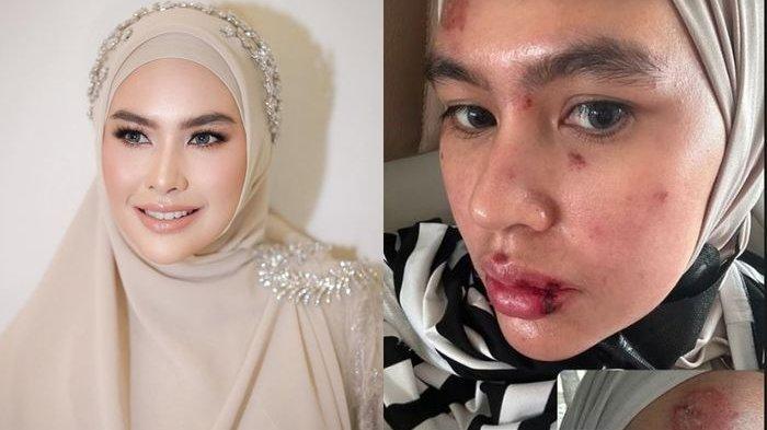 Kartika Putri Murka Usai Dituding Kena Karma Gegara Wajah Melepuh, Begini Kondisinya Sekarang Usai Dirawat di Singapura