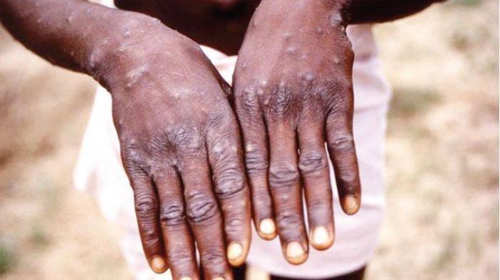 monkeypox