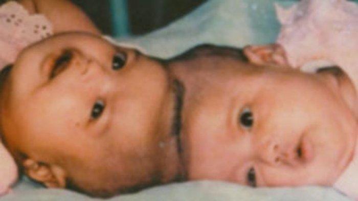 Yuliana dan Yuliani, kembar siam yang berhasil dipisahkan dan hidup normal.