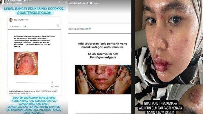 Bak Balas Sindirian Richard Lee, Kartika Putri Ungkap Penjelasan Dokter Soal Autoimun: Ilmu Gaib