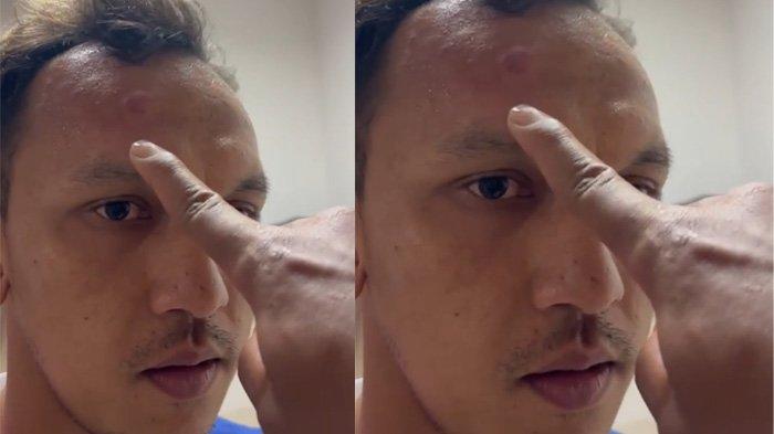 Kening pemain PSMS Medan Rachmad Hidayat benjol diduga akibat dipukuli oknum manajemen Persiraja seusai laga yang berakhir dengan skor kacamata di Stadion Harapan Bangsa, Banda Aceh, Sabtu (18/11/2023) malam.