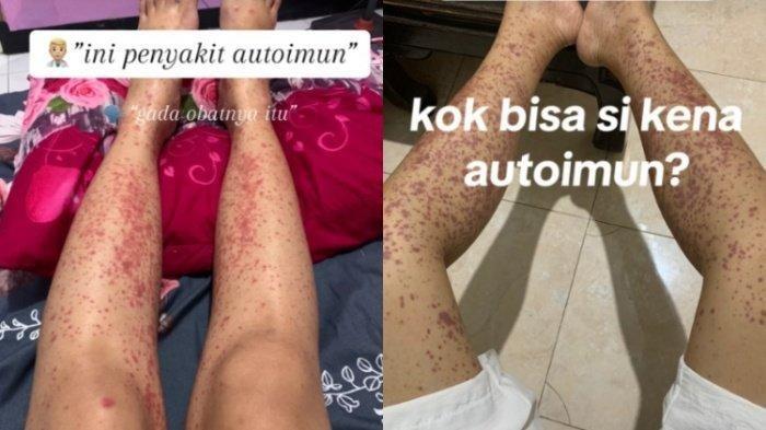 VIRAL Curhat Wanita Divonis Idap Autoimun Gara-gara Sering Jajan di Luar: Pola Makanku Gak Bergizi