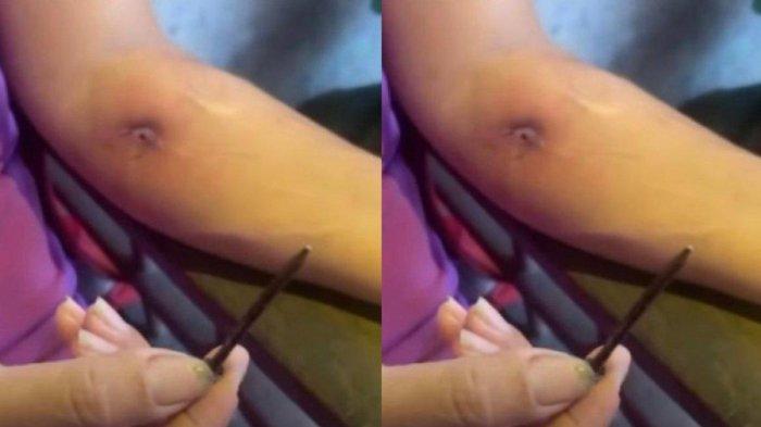 Lengan seorang wanita mampu mengeluarkan paku lewat luka yang terbuka.