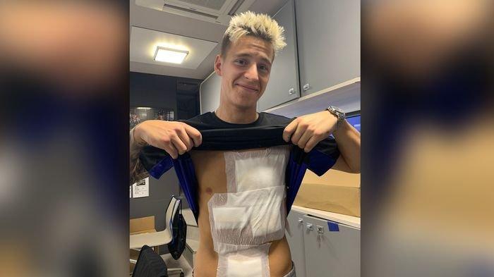 Pembalap Monster Energy Yamaha, Fabio Quartararo, menunjukkan luka memar pada dada dan perutnya akibat kecelakaan pada balapan MotoGP Aragon di Motorland Aragon, Spanyol, 18 September 2022.