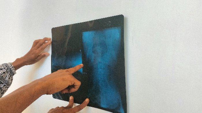 Penampakan hasil rongen peluru yang bersarang diperut Bela Cintia.