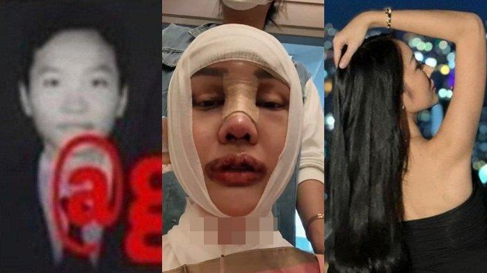 Lucinta Luna saat oplas