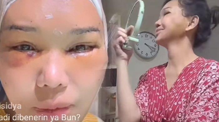 Penampakan wajah Bunda Corla pasca operasi