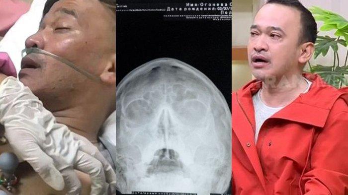 Ruben mengidap sakit langka, yakni Empty Sella Syndrome, seperti yang diderita Olga Syahputra