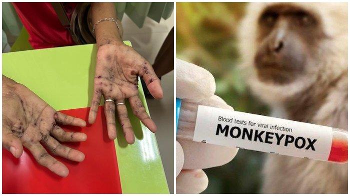 Telapak tangan seorang warga Palembang terjangkit cacar monyet.