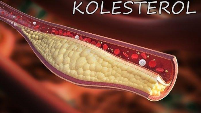 Ilustrasi - Kolesterol (TribunJabar)