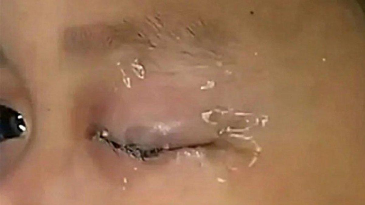 Ilustrasi mata anak kena lem super.