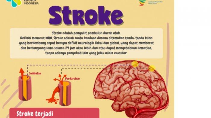 Ilustrasi terjadinya stroke