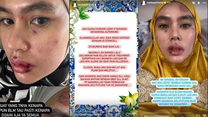 Artis Kartika Putri mengungkapkan awal mula wajah dan bibirnya mengalami luka melepuh. sejak 5 tahunan, ia didiagnosa Autoimun, kambuh gegara obat